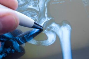 Living Well With Hip Osteoarthritis: Your Guide To Treatment And More